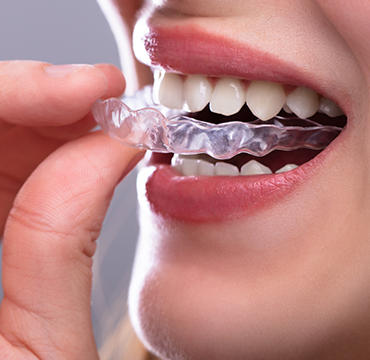 CLEAR ALIGNERS at Pearlline Multispeciality Dentocare the
                                                        best dental clinic in Hosur