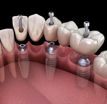  DENTAL IMPLANTS at Pearlline Multispeciality Dentocare the
                                                        best dental clinic in Hosur