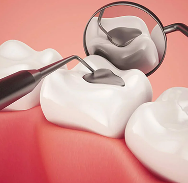 DENTAL FILLINGS at Pearlline Multispeciality Dentocare the
                                                        best dental clinic in Hosur