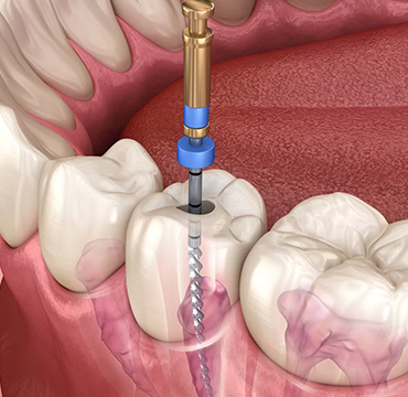 ROOT CANAL TREATMENT at Pearlline Multispeciality
                                                        Dentocare the best dental clinic in Hosur
