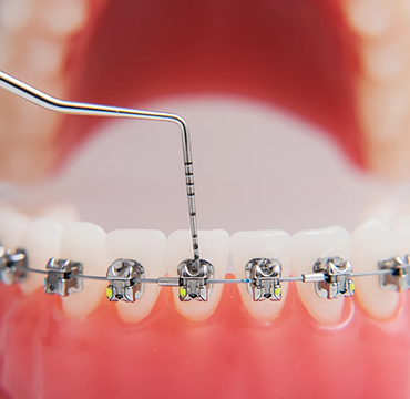 BRACES at Pearlline Multispeciality Dentocare the best dental
                                                        clinic in Hosur