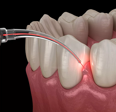 LASER ASSISTED PROCEDURE at Pearlline Multispeciality
                                                        Dentocare the best dental clinic in Hosur