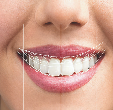 Digital Smile Design (DSD) at Pearlline Multispeciality
                                                        Dentocare the best dental clinic in Hosur