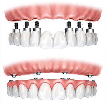 Full Mouth Rehabilitation at Pearlline Multispeciality Dentocare
                                                        the best dental clinic in Hosur